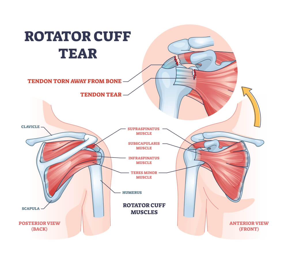https://www.restoredhopetherapy.com/wp-content/uploads/2023/11/rotator-cuff-tear.jpg